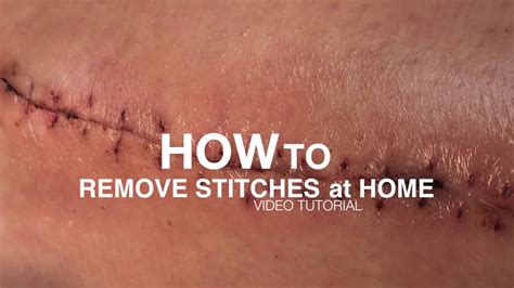 How To Remove Stitches At Home Youtube