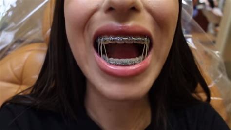 Braces Girlswithbraces Metalbraces Elastics Powerchain Braces Girls Dental Braces Teeth