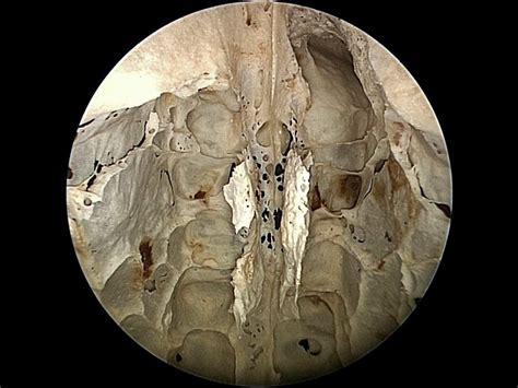 Inferior Endoscopic View Of Ethmoid Bone Complex Neuroanatomy The