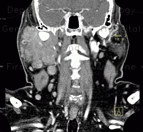 Radiology Case Lymphoma Of Parotid Gland Lymphadenopathy