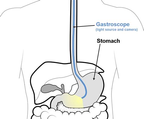 Gastroscopy Coffs Harbour Surgical