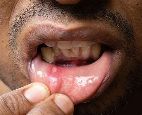 Mouth Ulcers Types Causes And Treatment