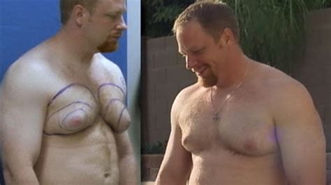 Gynecomastia Male Breasts Not Life Threatening But Can Be Psychologically Damaging Abc News