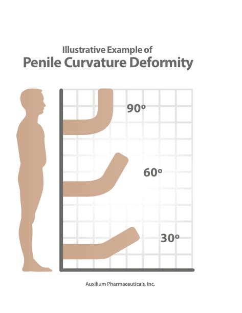 Possible Help For Men With Peyronies Crooked Penis Disease Wbur News