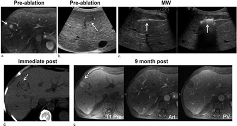 Microwave Ablation For The Treatment Of Hepatic Adenomas Journal Of