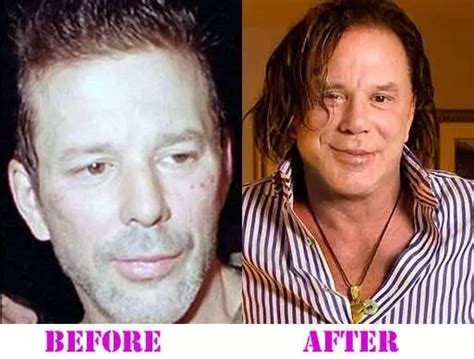 Mickey Rourke Plastic Surgery With Before And After Photos