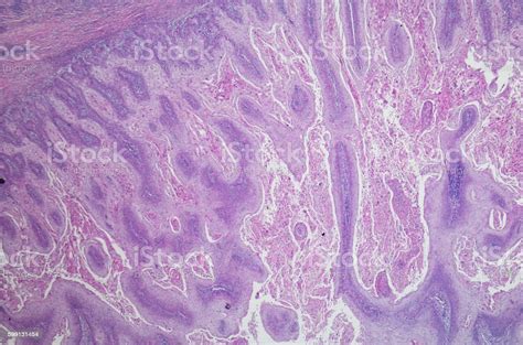 Micrograph Of Squamous Cell Carcinoma Of The Head And Neck Stock Photo