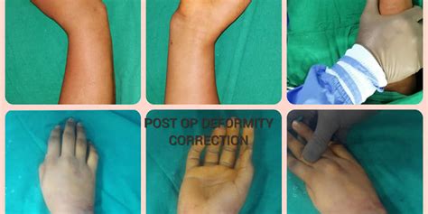 Madelungs Deformity Correction For 15 Yrs Male With Corrective Open
