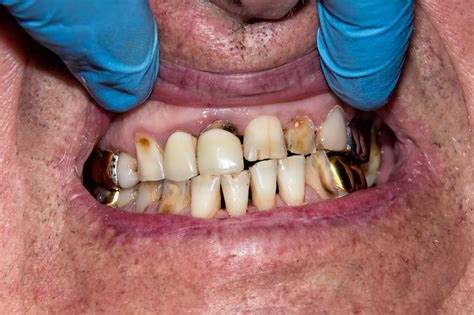 Rotten Teeth Extraction In Hiv Patients