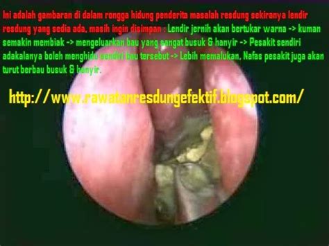 Berbeza bagi setiap individu dimana masalah sinus sensitivity bergantung kepada tahap alergik badan seseorang terhadap beberapa benda seperti habuk. RAWATAN RESDUNG PALING MUJARAB (SA0281866-M): Tanda-tanda ...