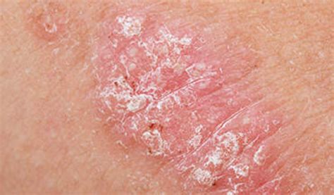 Psoriasis Dermatology Conditions And Treatments