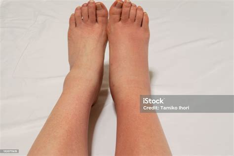 A Leg With The Symptom Of Bacterial Cellulitis Stock Photo Download