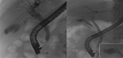 Subtotal Cholecystectomy Fenestrating Vs Reconstituting