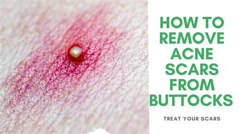 How To Remove Acne Scars From Buttocks Naturally Treat Your Scars