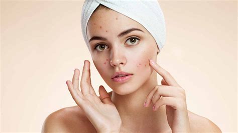 Acne A Bane For Youth A Proper Acne Skin Care Routine Is By Pooja