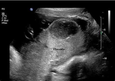 Fundal Placenta Ultrasound
