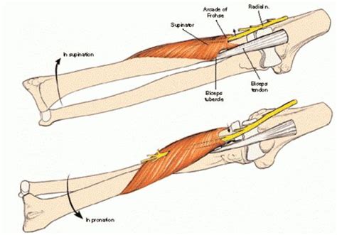 Radial Nerve Entrapment At The Elbow Radial Tunnel Syndrome And