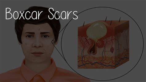 What Causes Boxcar Acne Scars Youtube