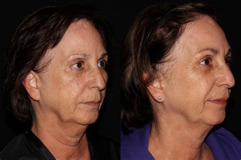 BBL PhotoFacial Before And After Pictures Case Chico Yuba City Oroville CA Hodari