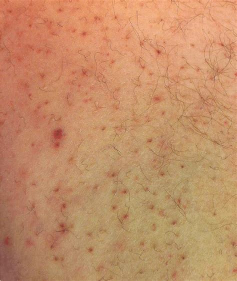 Large Dusky Violaceous Ecchymosis On Right Lateral Thigh Figure 2