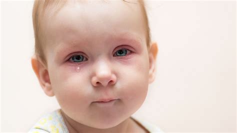 Zapalenie spojówek u dzieci objawy przyczyny leczenie rodzaje