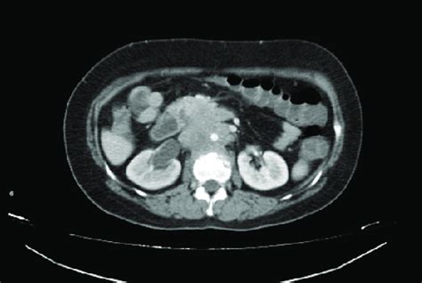 Abdomen And Pelvic Ct Scan With Contrast Showing An Infiltrating