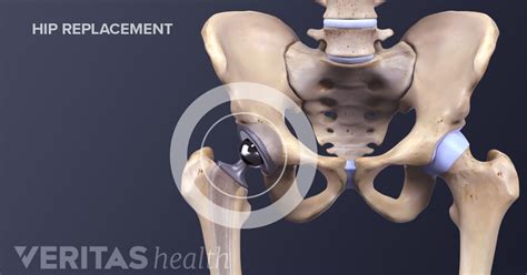 17 To Do Items Before Hip Replacement Surgery
