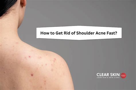 How To Get Rid Of Shoulder Acne Fast