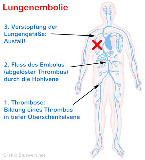 Thrombosis occurs when a thrombus, or blood clot, develops in a blood vessel and reduces the flow of blood through the vessel. Thrombose - Risiko durch Blutgerinnsel-Bildung