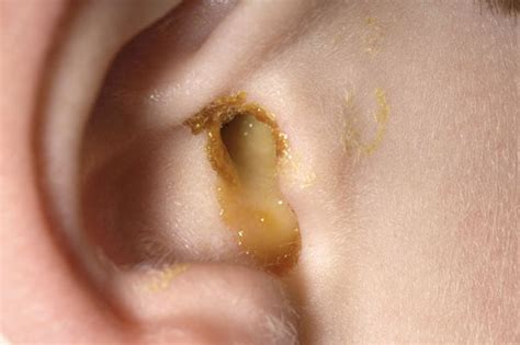 Ear Discharge Causes Treatments And Prevention Evolving World