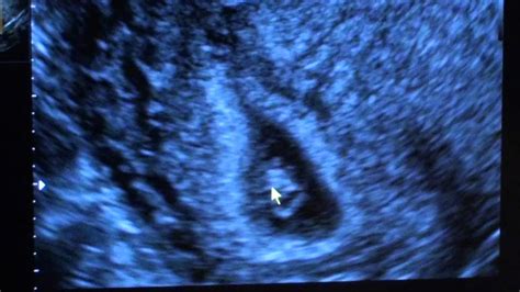 6 Weeks 4 Days Ultrasound Twins Youtube