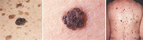 Seborrheic Keratosis Dermatologist Mohs Skin Cancer Laser Hot Sex Picture