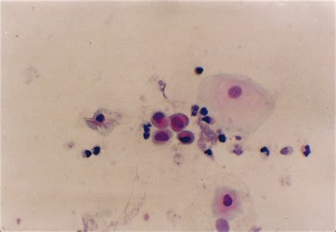 Pap Stain Of Sputum Showing Squamous Cell Metaplasia With Atypia