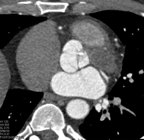 Calcified Aortic Valve With Dilated Ascending Aorta Cardiac Case