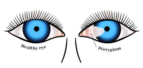 Pterygium San Jose Eye Doctor Santa Clara Spectrum Eye Physicians