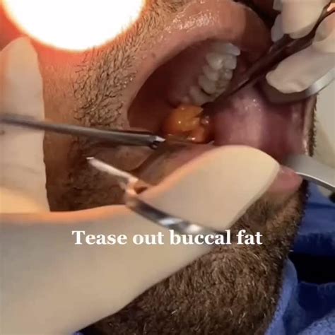 Buccal Fat Removal The Procedure Video RealSelf