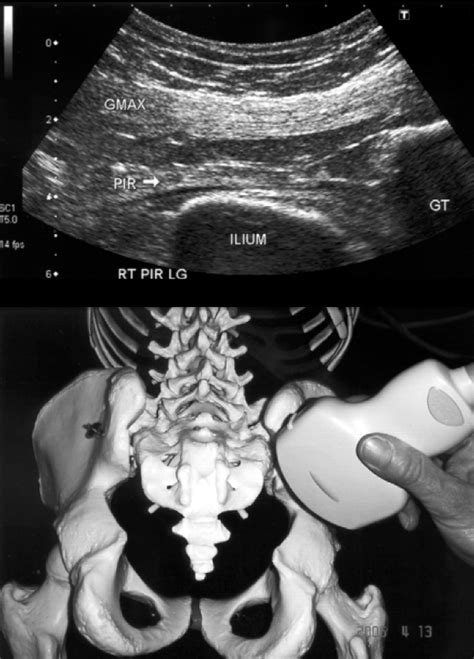 Piriformis Syndrome Ultrasound