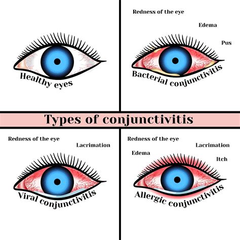 Bacterial Conjunctivitis Treatment All About Bacteria Images
