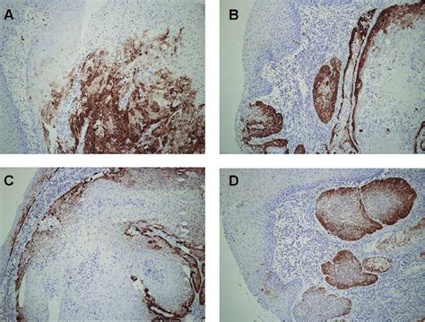 Expression Of P16 In Oropharyngeal Cancer Cells Immunohistochemistry