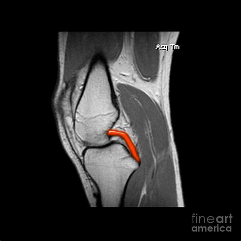 A Normal Posterior Cruciate Ligament Pcl This Sagittal T Weighted My