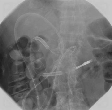 Abdominal Radiograph Taken 28 Days After Gastrojejunostomy Tube