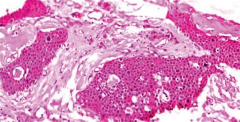 An Atypical Presentation Of Pindborg Tumor In Anterior Maxilla