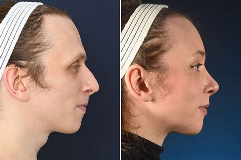 facial feminization surgery brow lift feminizing the eyebrows 2pass clinic