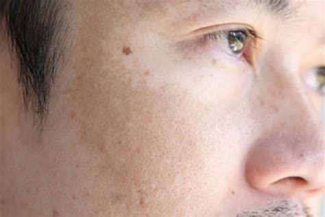 The Lowdown On Sun Damage Bakersfield Dermatologist