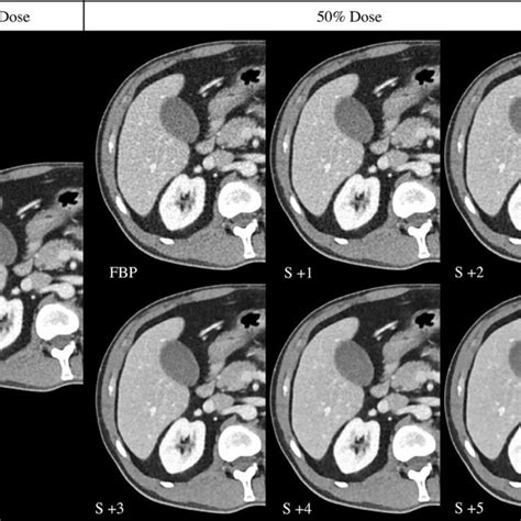 Transverse Abdominal Ct Images In A 56 Year Old Male Reconstructed With