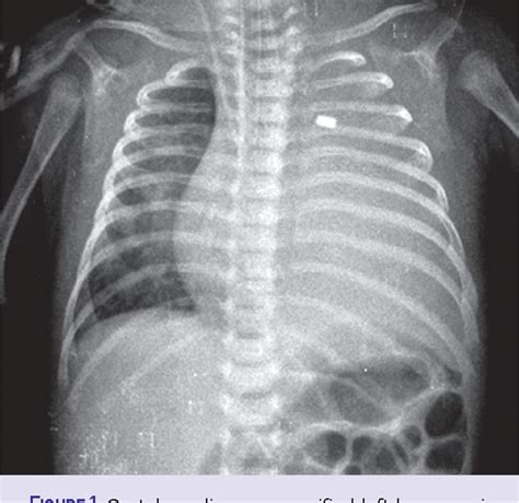 Figure 1 From Treatment Of Chylothorax Developed After Congenital Heart