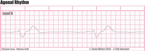 Ecg Educator Blog Agonal Rhythm