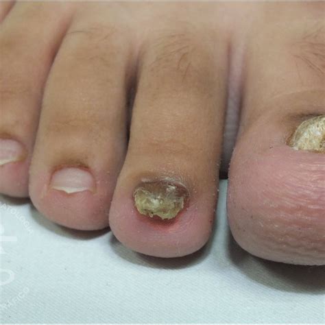 Lateral Distal Subungual Onychomycosis With Yellowish Discoloration And