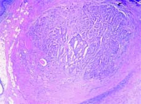 Lung carcinoid tumors are an uncommon type of tumor that starts in the lungs. Tejido tiroideo con folículos y foco de tumor carcinoide ...