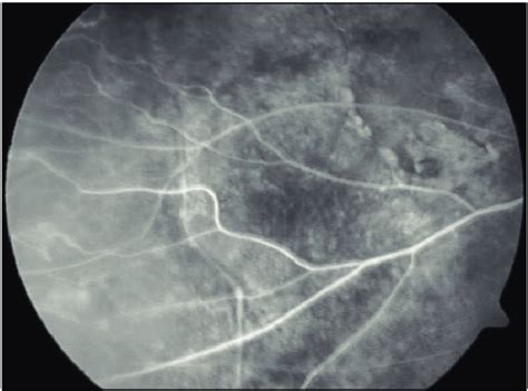 Peripheral Retinal Ischemia In The Temporal Quadrant Of The Right Eye